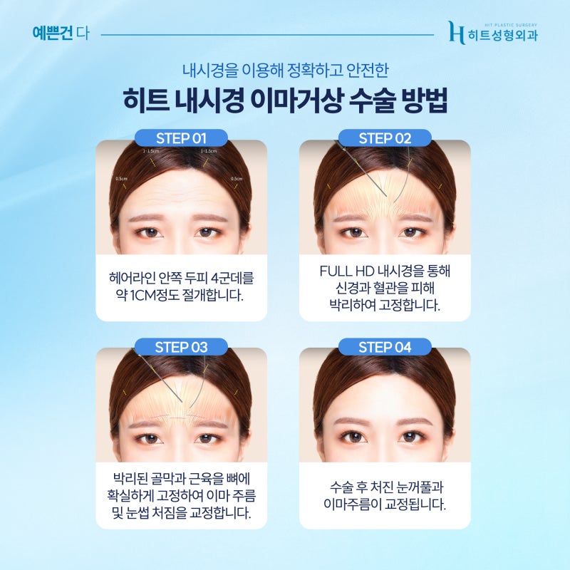 [히트성형외과] 이마주름으로 인한 어둡고 답답한 인상 해결법, 히트 내시경 이마거상 사진 5