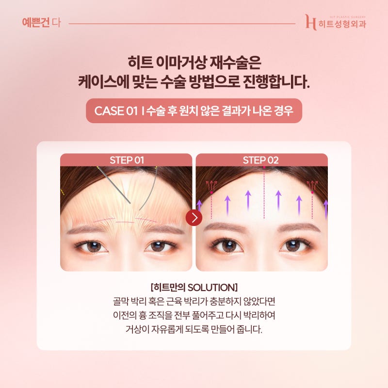 [히트성형외과] 이마거상 재수술, 원인에 맞는 해결책으로 사진 3