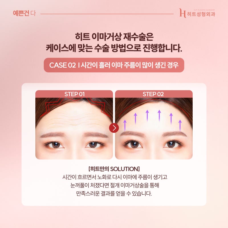 [히트성형외과] 이마거상 재수술, 원인에 맞는 해결책으로 사진 4