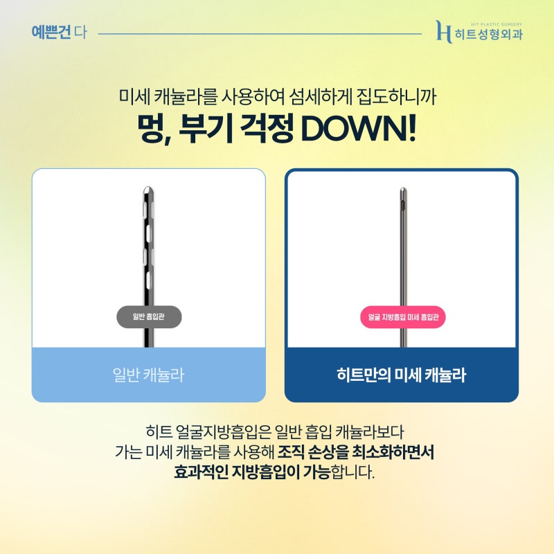 [히트성형외과] 남자들의 이중턱 고민, 히트 얼굴지방흡입으로 더 세련되게 사진 4