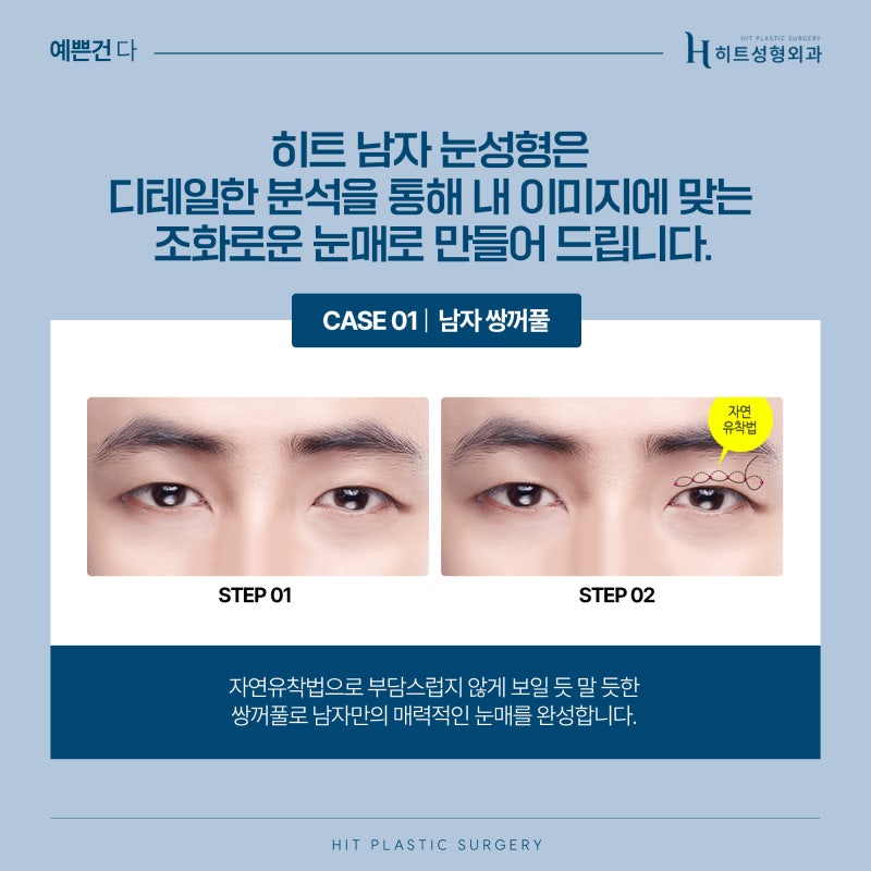 [히트성형외과] 남자를 위한 자연스러운 맞춤 눈성형 사진 4