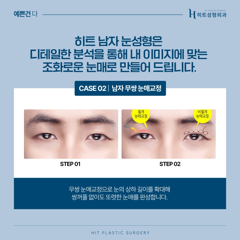 [히트성형외과] 남자를 위한 자연스러운 맞춤 눈성형 사진 5