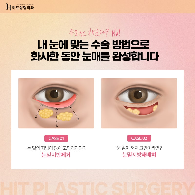 [히트성형외과] 피곤해 보이는 눈매라면? 눈밑지방재배치! 사진 3