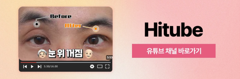 [히트성형외과] 피곤해 보이는 눈매라면? 눈밑지방재배치! 사진 8