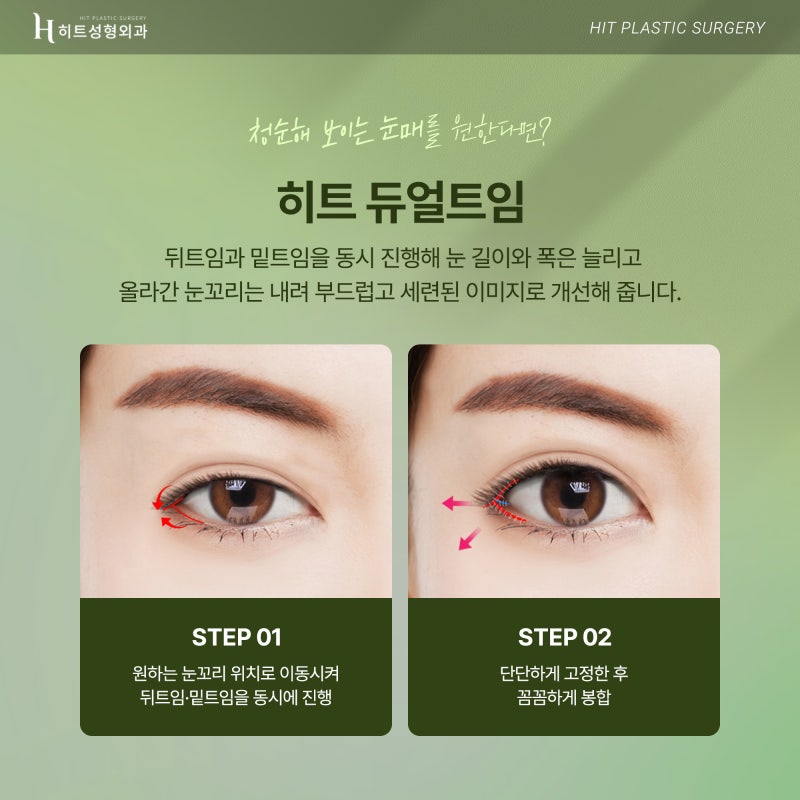 [히트성형외과] 히트 트임성형으로 시원하고 또렷하게! 사진 5