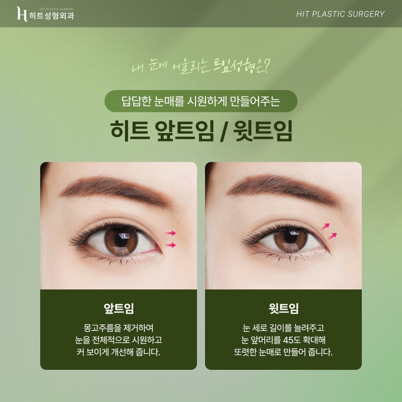 [히트성형외과] 히트 트임성형으로 시원하고 또렷하게! 사진 3