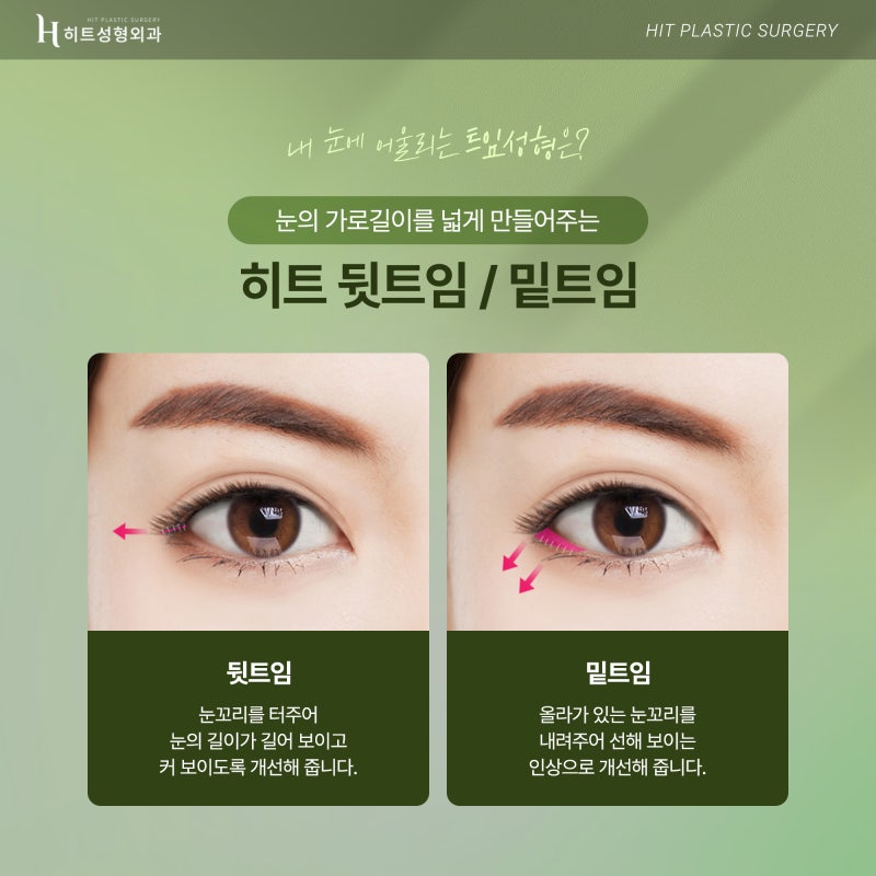 [히트성형외과] 히트 트임성형으로 시원하고 또렷하게! 사진 4