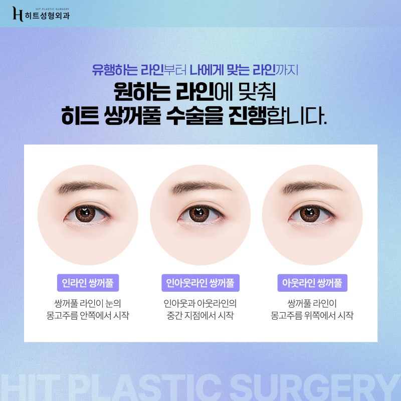 [히트성형외과] 쌍꺼풀 수술, 눈매교정 어떤 차이가 있을까? 사진 4
