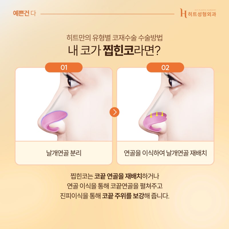 [히트성형외과] 코재수술 유형은 어떤 것들이 있을까? 사진 3