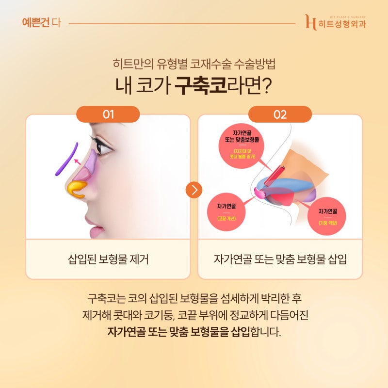 [히트성형외과] 코재수술 유형은 어떤 것들이 있을까?