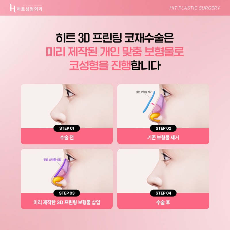 [히트성형외과] 내 코에 딱 맞추자! 3D프린팅 맞춤보형물 사진 4