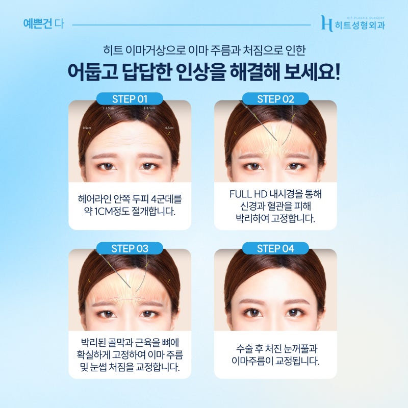 [히트성형외과] 이마부터 눈까지 한 번에 눈성형+이마거상 사진 4