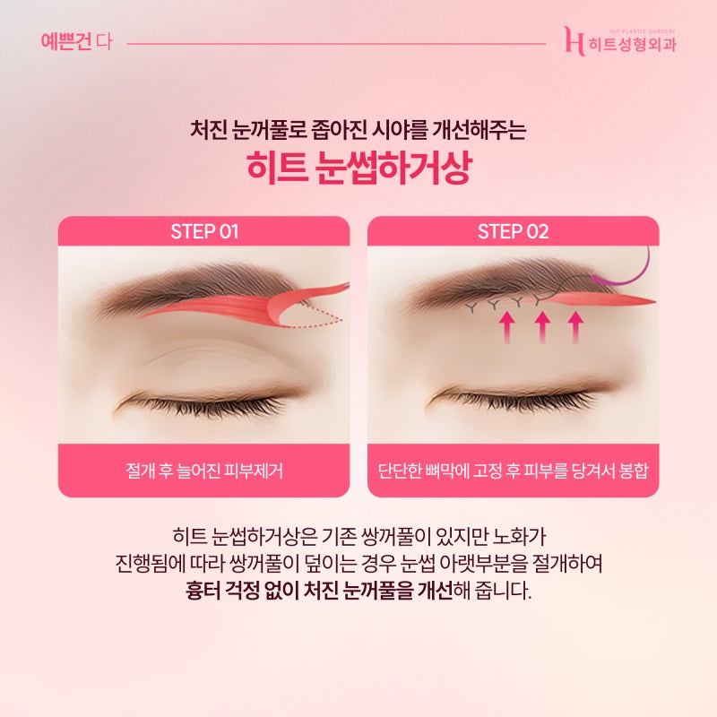 [히트성형외과] 눈성형, 연령대별로 알아보자! 사진 6