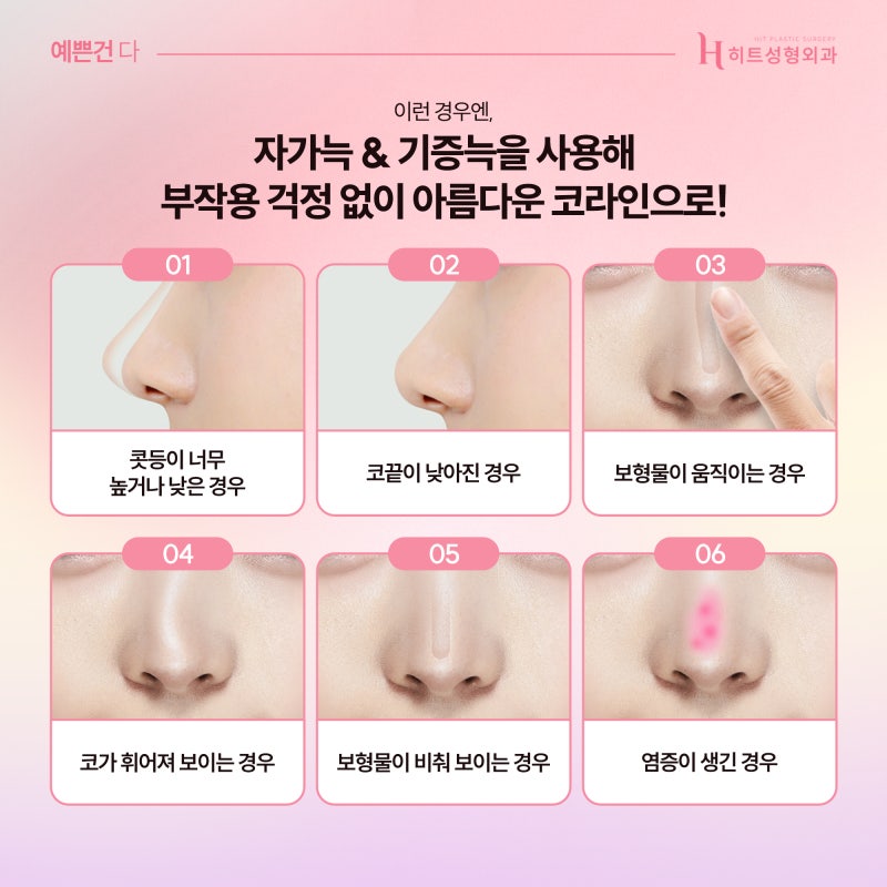 [히트성형외과] 코수술시 사용되는 자가늑 기증늑, 어떤 재료가 좋을까? 사진 5