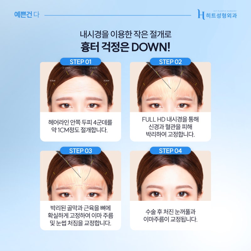 [히트성형외과] 이마 주름과 처짐, 한 번에 해결하고 싶다면? 사진 5