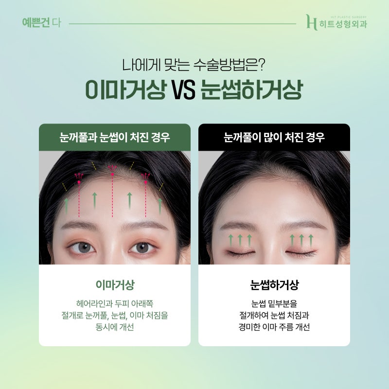 [히트성형외과] 이마거상, 눈썹하거상 어떤 차이가 있을까?