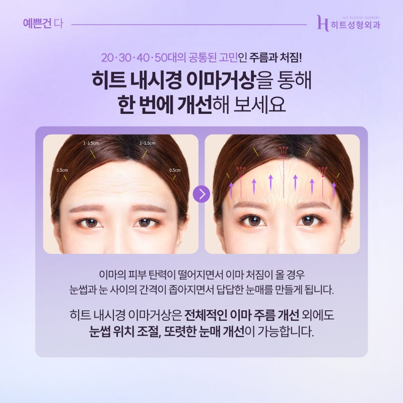[히트성형외과] 이마거상, 나이 든 사람만 하는 걸까? 사진 4