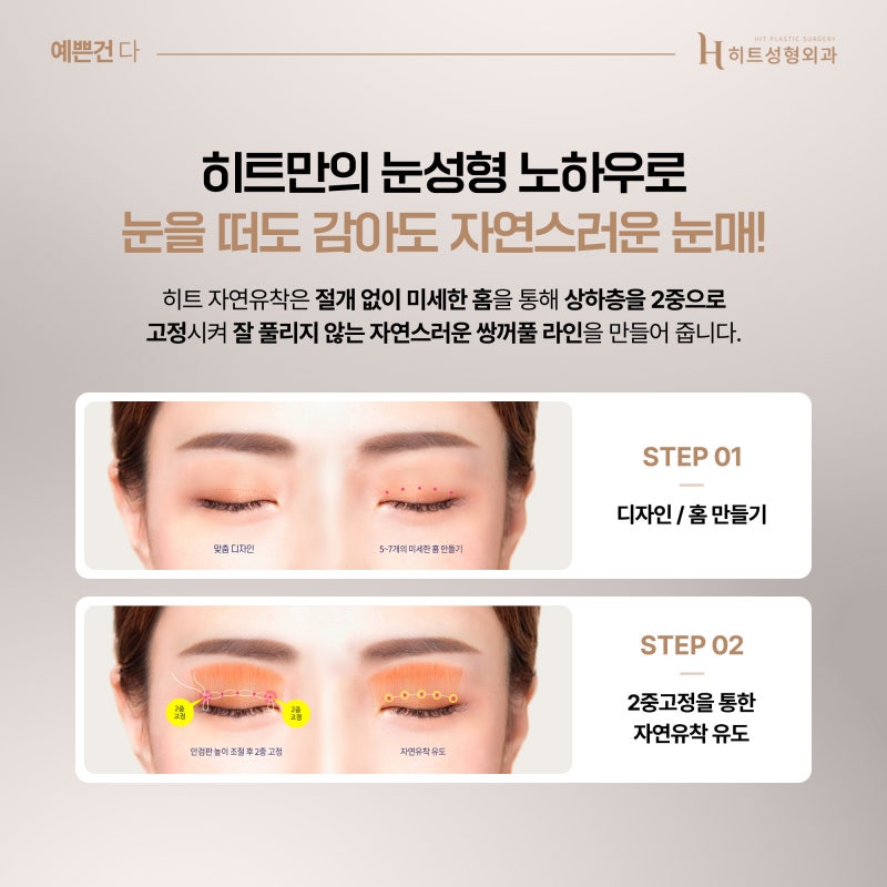 [히트성형외과] 강아지 눈매 VS 고양이 눈매 원하는 느낌에 따라! 사진 4
