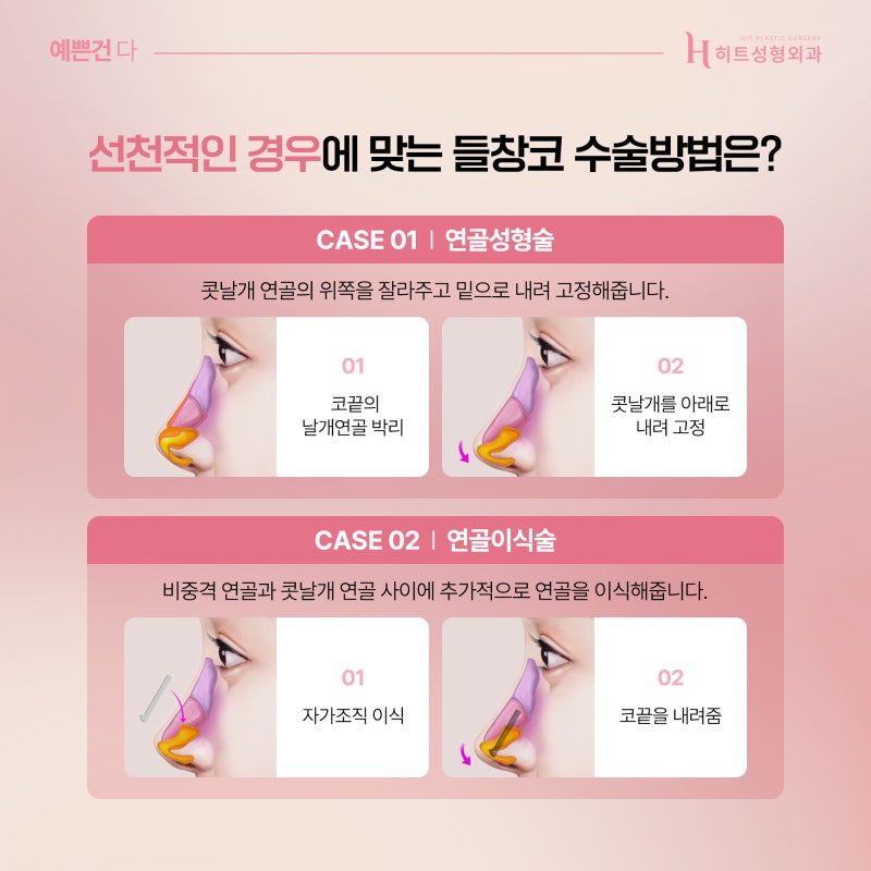 [히트성형외과] 정면에서 봤을 때 콧구멍이 보인다면, 들창코일까? 사진 3