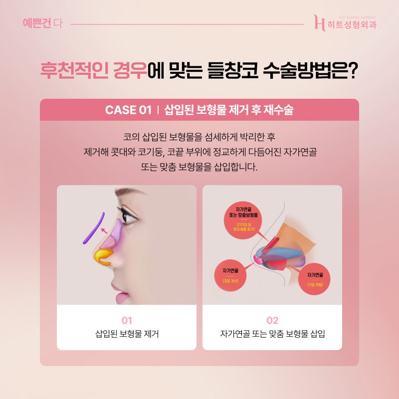 [히트성형외과] 정면에서 봤을 때 콧구멍이 보인다면, 들창코일까? 사진 4