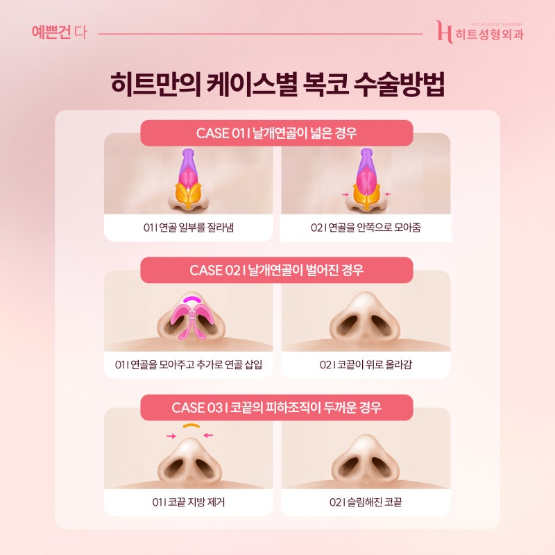 [히트성형외과] 복코, 콧볼 축소만으로 개선이 가능할까? 사진 5
