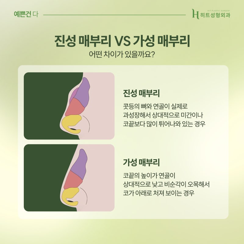 [히트성형외과] 매부리코 종류별 특징은? 사진 3