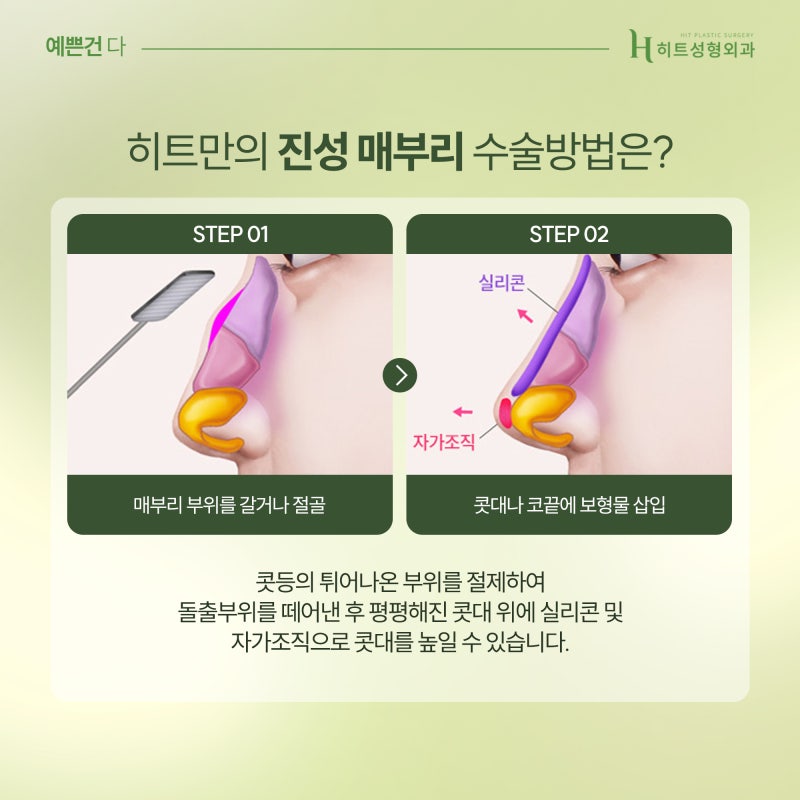 [히트성형외과] 매부리코 종류별 특징은? 사진 4