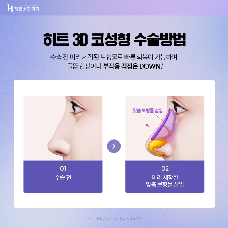 [히트성형외과] 수술 전, 코필러를 꼭 제거해야 하나요? 사진 5