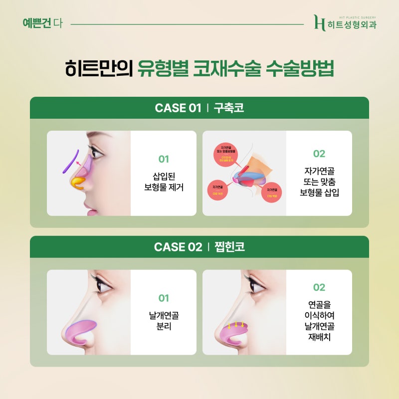 [히트성형외과] 코재수술, 골든타임은 언제일까요? 사진 4