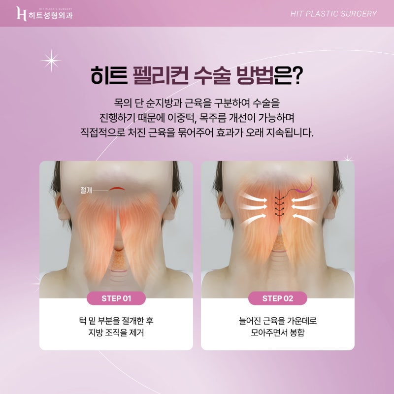 [히트성형외과] 목과 턱의 경계를 찾아주다, 히트 펠리컨 수술! 사진 3