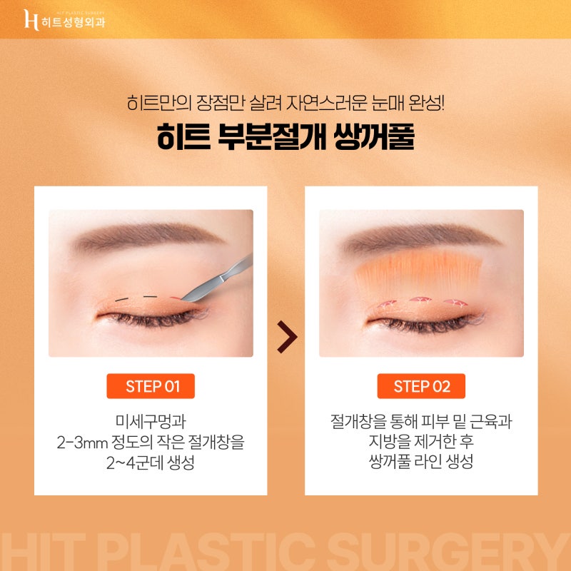 [히트성형외과] 히트 쌍꺼풀 수술의 모든 것! 사진 4
