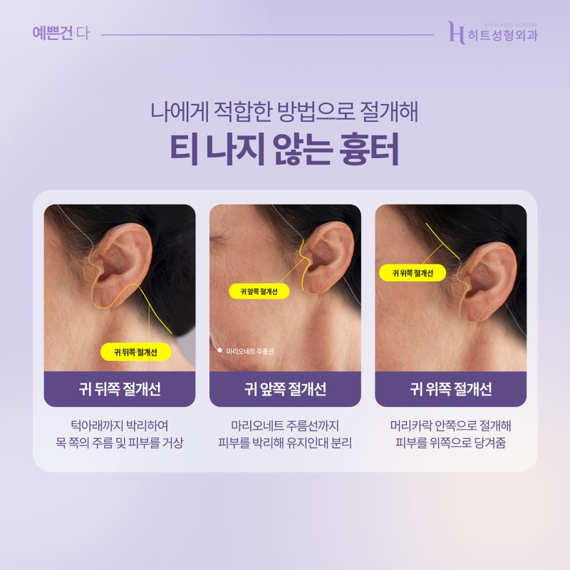 [히트성형외과] 히트 SMAS 안면/목거상 ! 사진 3