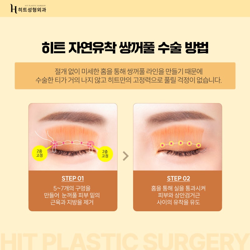 [히트성형외과] 나에게 맞는 쌍꺼풀 라인의 높이는? 사진 5
