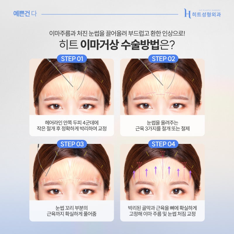 [히트성형외과] 히트만의 대표적인 동안 성형은? 사진 4