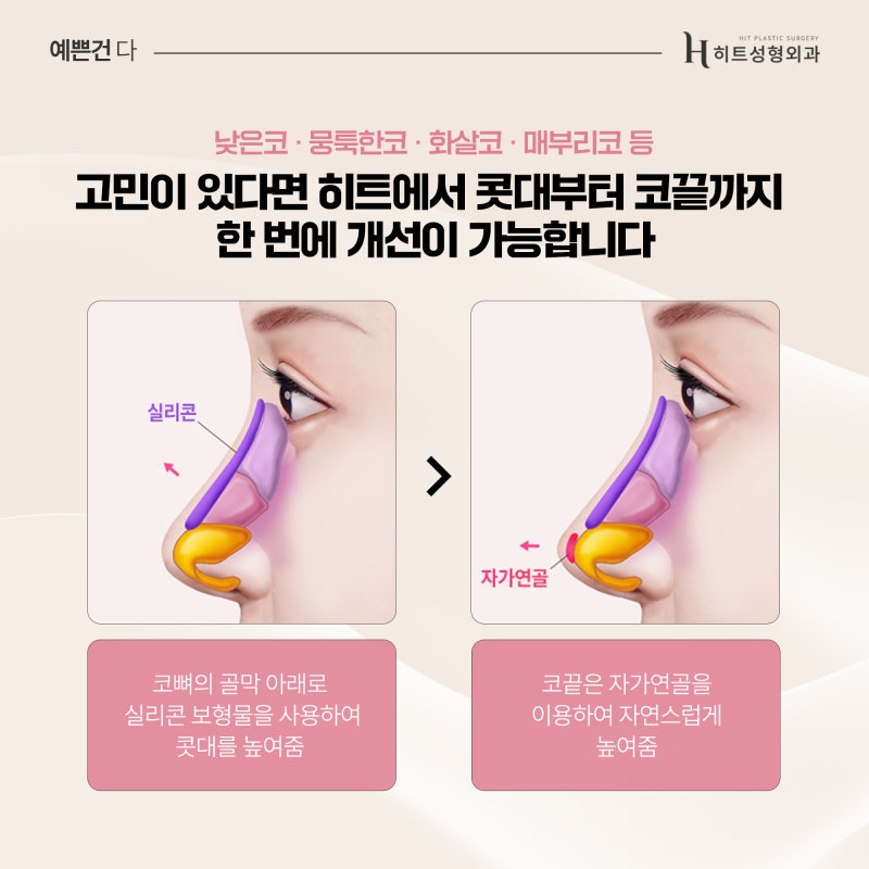 [히트성형외과] 코끝 처짐, 재료에 따라 달라질까요? 사진 5