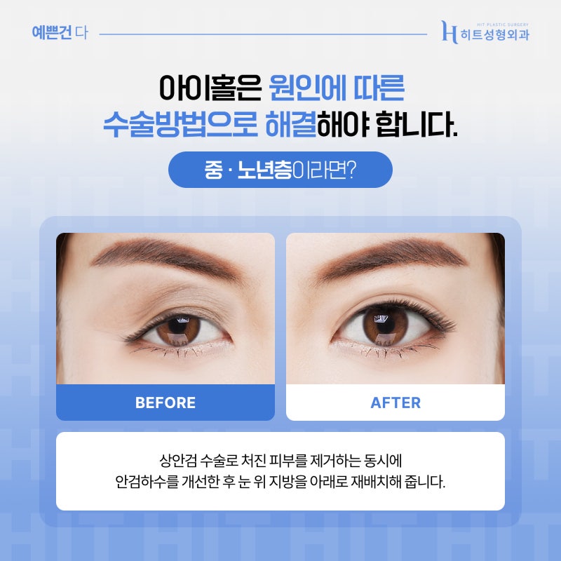 [히트성형외과] 아이홀이 생기는 원인은? 사진 4