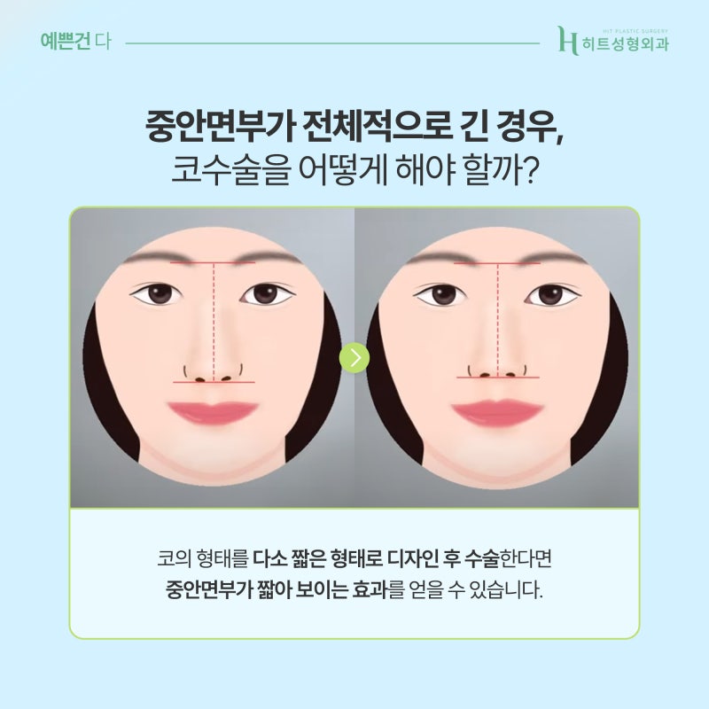 [히트성형외과] 중안면부가 긴 얼굴, 코 수술 방법은? 사진 4
