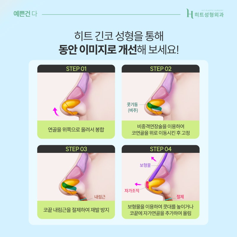 [히트성형외과] 중안면부가 긴 얼굴, 코 수술 방법은? 사진 6
