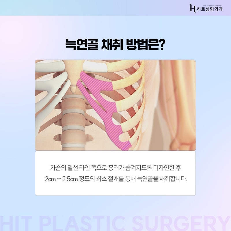 [히트성형외과] 코 수술, 늑연골로 한다면? 사진 4