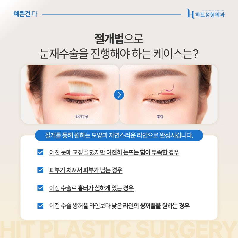 [히트성형외과] 눈 재수술 자연유착으로 가능할까? 사진 4