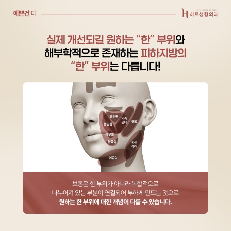 [히트성형외과] 얼굴지방흡입 조화로운 수술 방법은? 사진 3