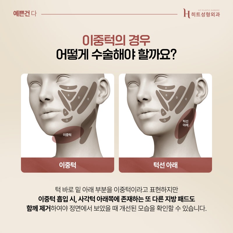 [히트성형외과] 얼굴지방흡입 조화로운 수술 방법은? 사진 4