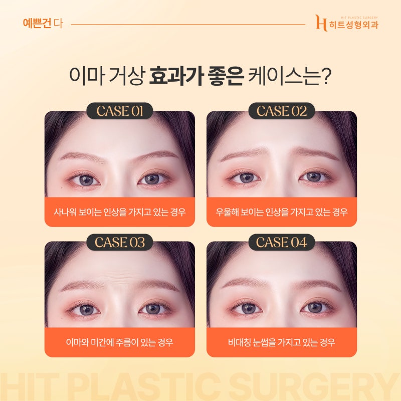 [히트성형외과] 이마거상 수술 후, 얼마나 오랫동안 유지될까? 사진 4