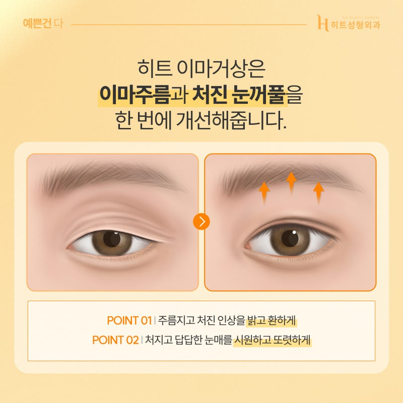 [히트성형외과] 쌍꺼풀 수술 or 이마거상! 나에게 맞는 수술 방법은? 사진 5