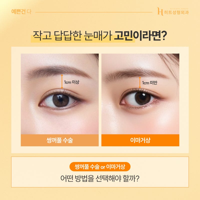 [히트성형외과] 쌍꺼풀 수술 or 이마거상! 나에게 맞는 수술 방법은?