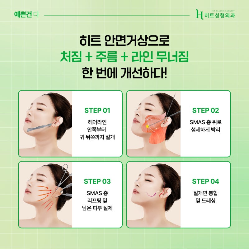 [히트성형외과] 안면거상, 자연스러워지는 시기는 언제일까요? 사진 3