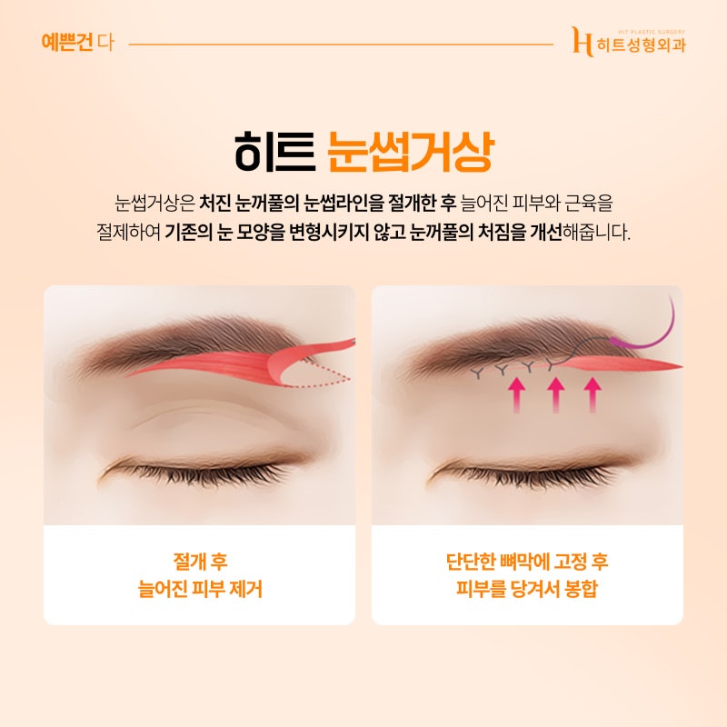 [히트성형외과] 눈매교정 눈썹거상 이마거상 각 수술의 차이점은? 사진 4