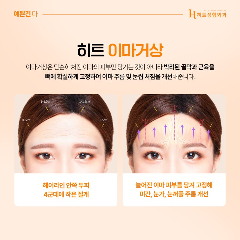 [히트성형외과] 눈매교정 눈썹거상 이마거상 각 수술의 차이점은? 사진 5