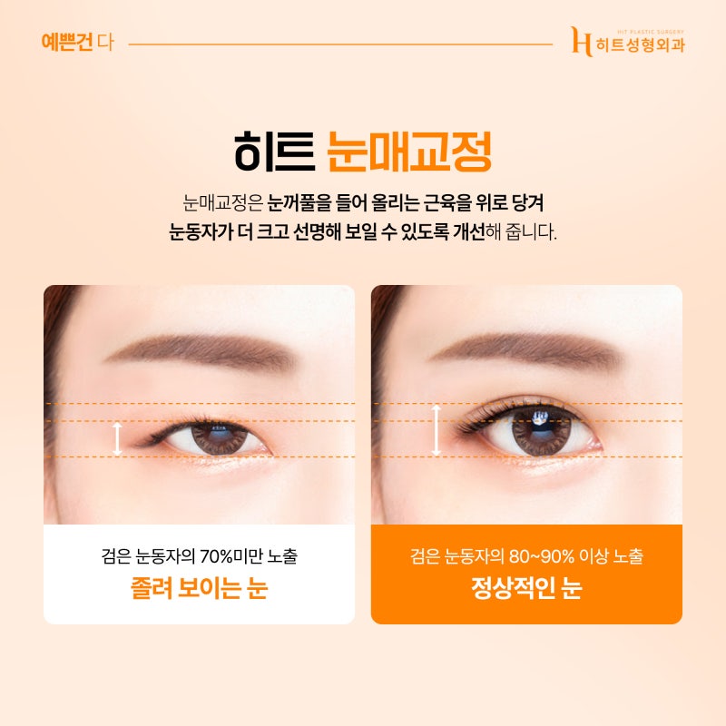 [히트성형외과] 눈매교정 눈썹거상 이마거상 각 수술의 차이점은? 사진 3
