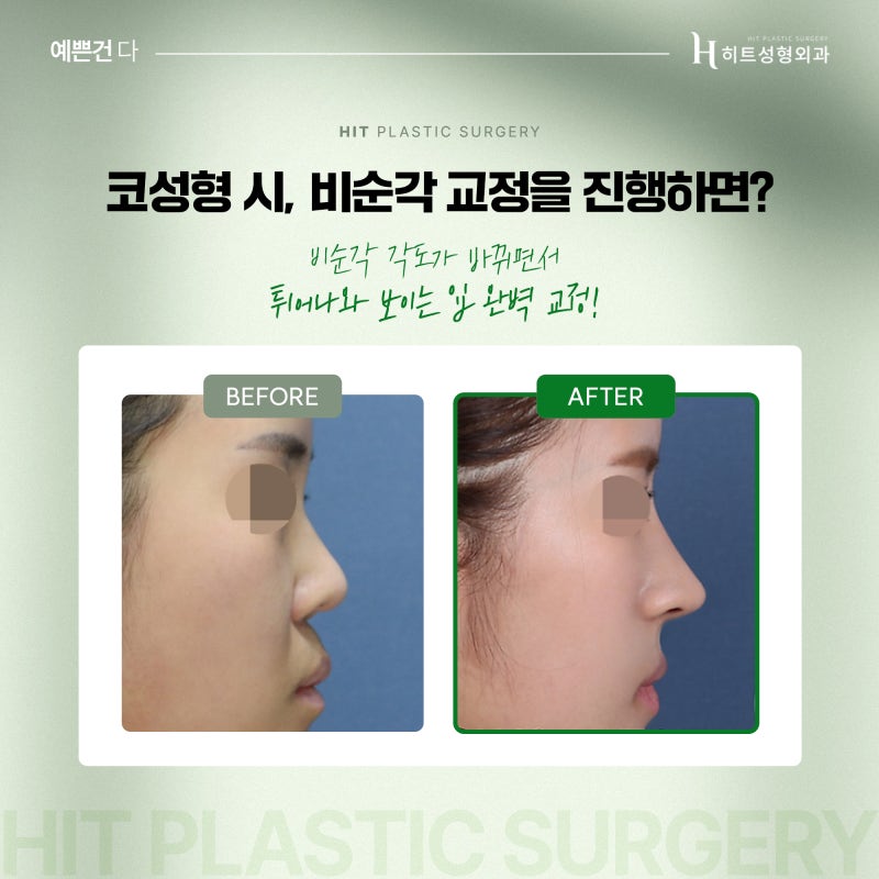 [히트성형외과] 비순각교정으로 튀어나온 입을 개선할 수 있다? 사진 3